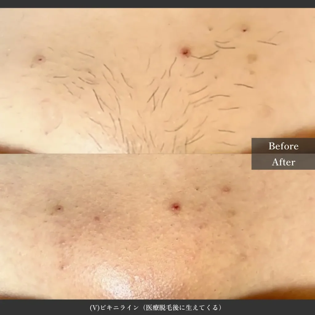 豊橋医療脱毛
その後のVIO