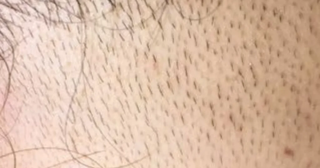 自己処理=カミソリ
セルフ脱毛NG