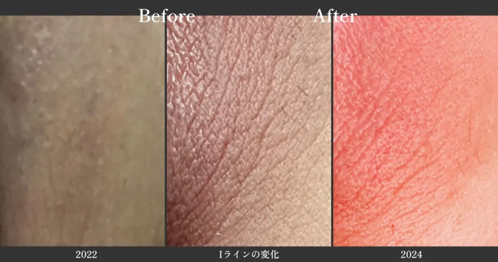 VIOの黒ずみが定期的なシュガーリング薄くなっていく変化