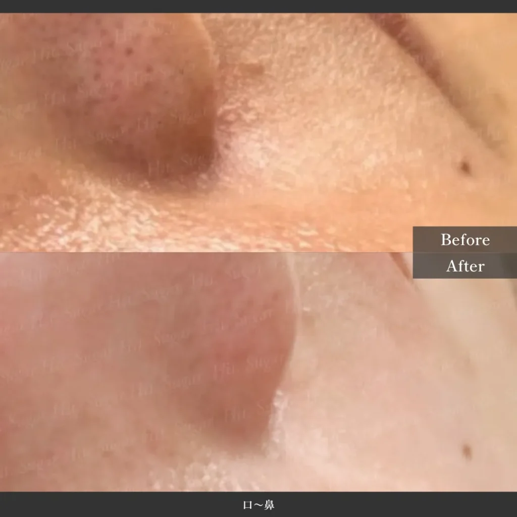 豊橋顔脱毛
フェイシャルワックス